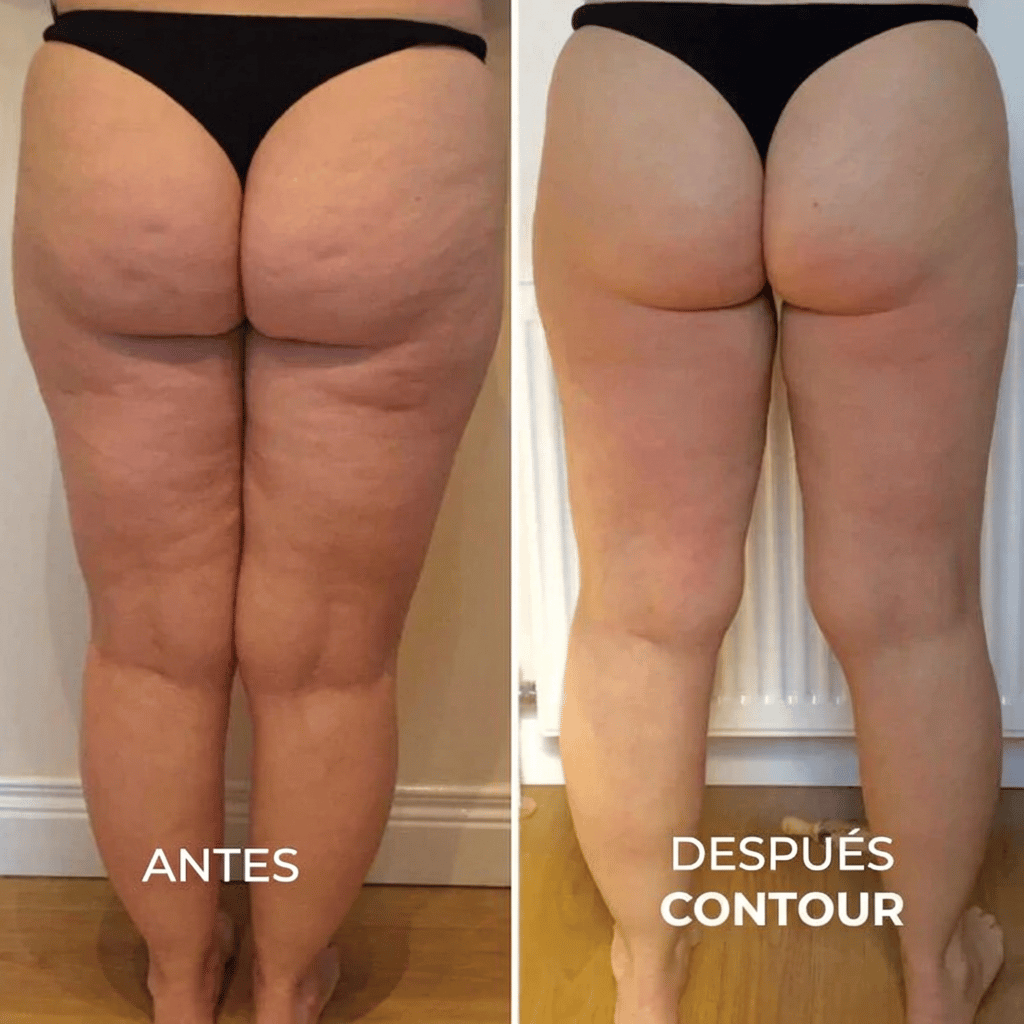 Resultados abdomen antes y después